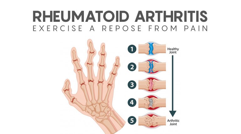 Rheumatoid Arthritis :Exercise a repose from pain.